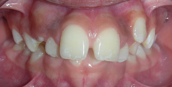 Children teeth before perth orthodontic treatment for severe dental crowding and misalignment